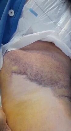 Doña Gladys Martínez está hospitalizada desde el jueves 11 de enero y aún no la operan de una fractura en el fémur.