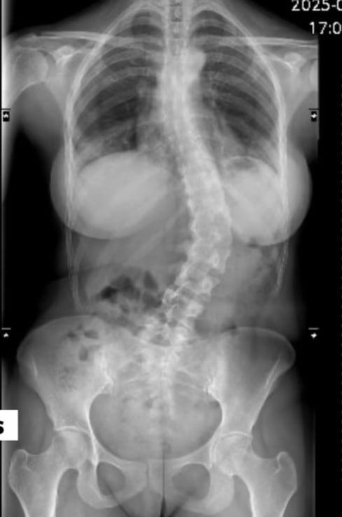 Ginnés Rodríguez, presentadora de Las Historias, y su historia sobre la escoliosis que sufre desde los 15 años.