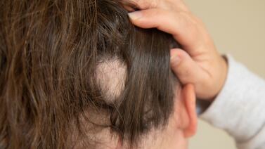 Bájele al estrés porque le puede hacer perder cabello en grandísimas cantidades