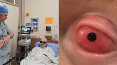 A un hombre le implantaron un diente en el ojo y recuperó la vista tras 20 años de ceguera