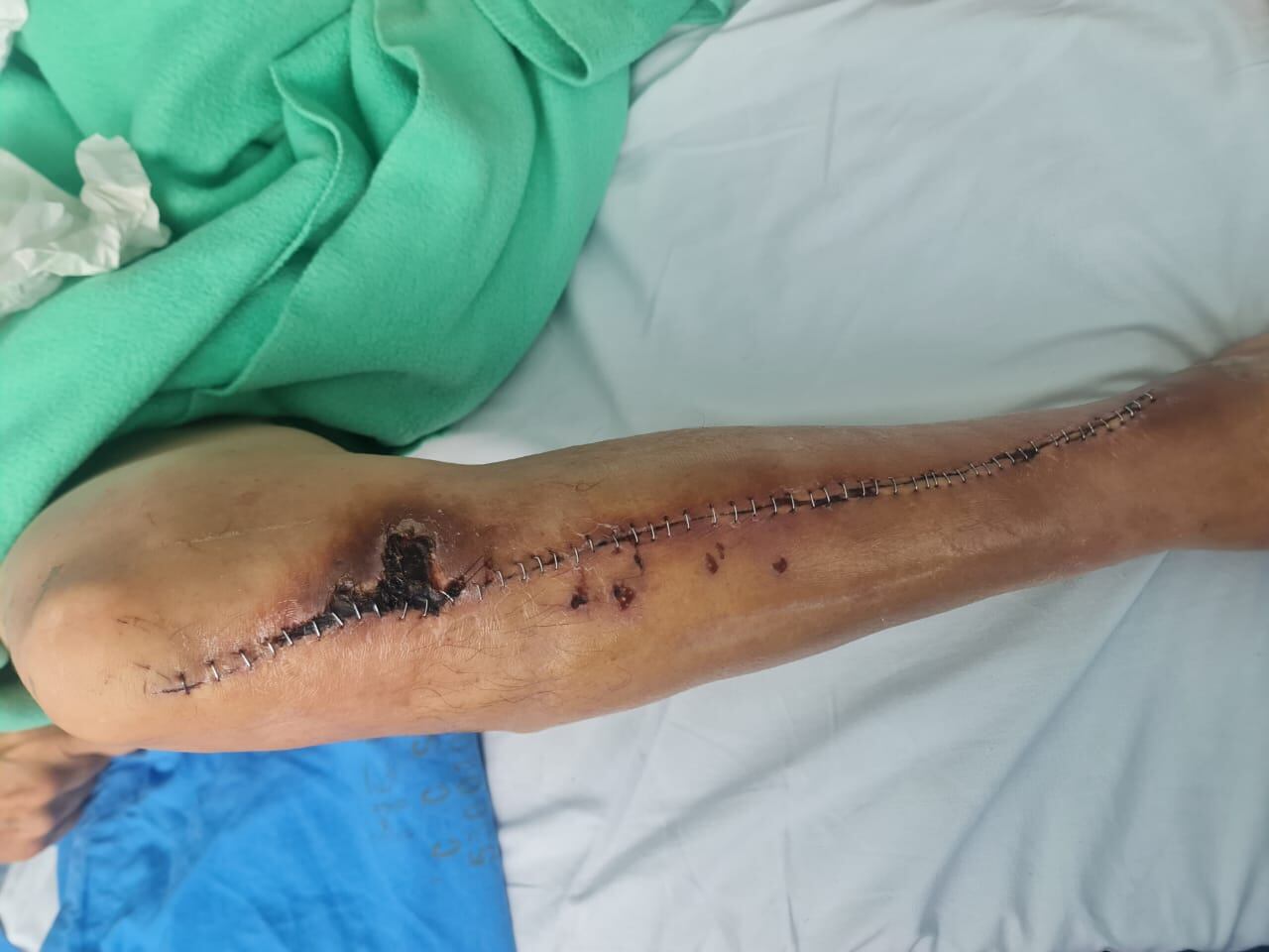 Guillermo Antonio Ulate, le sacan pin de la pierna derecha tras 30 años