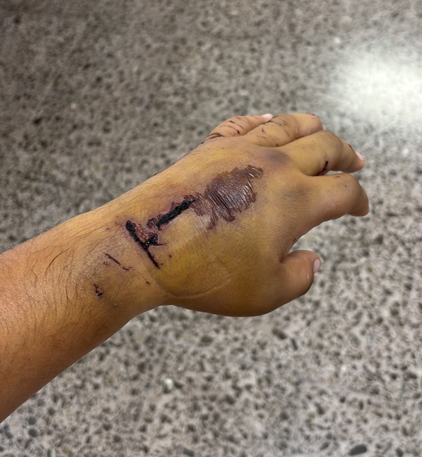 Jason Ureña, periodista de Telenoticias, tras su accidente en Limón.