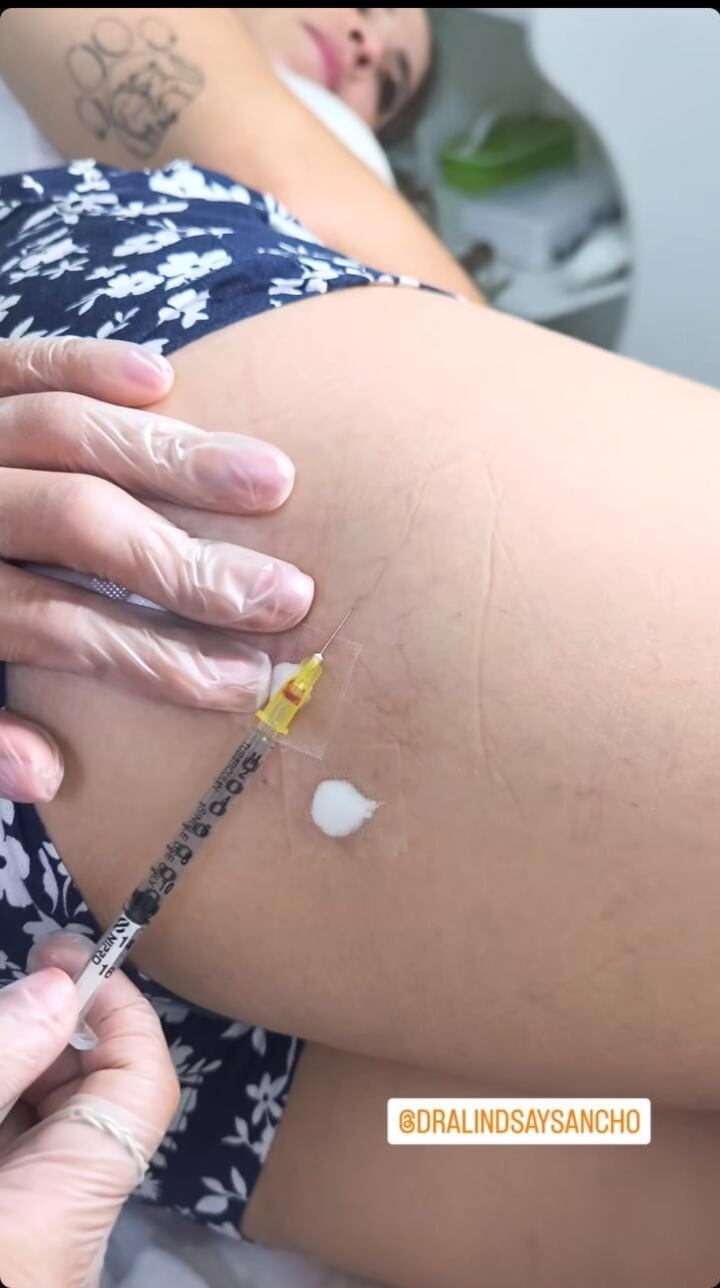 Gipzy Montaya recibió doloroso tratamiento