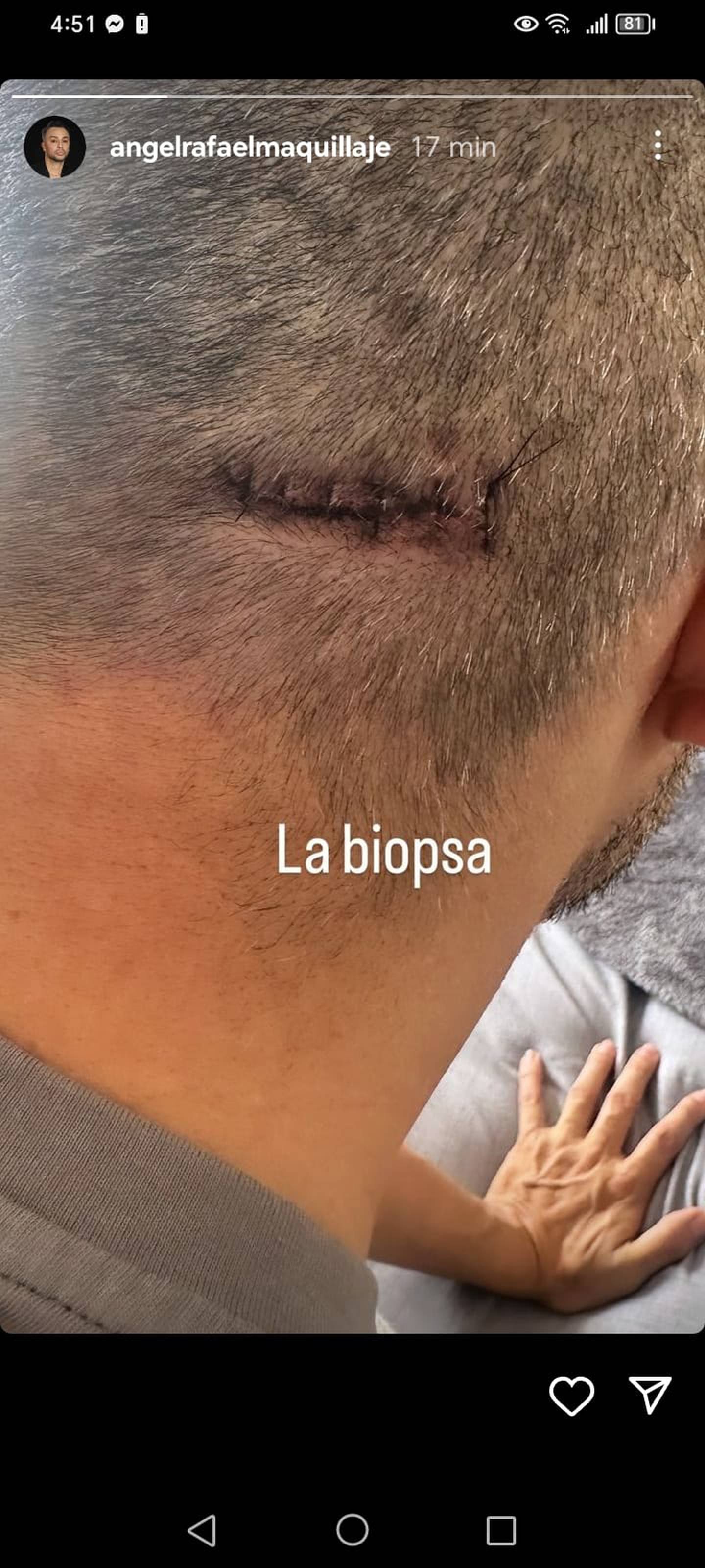 Hace pocos minutos, este Jueves Santo, el exmaquillista de Teletica, Ángel Rafael, mostró la cicatriz de la biopsia en el cerebro que le hicieron como parte del proceso que debe llevar tras ser diagnosticado con un tumor cerebral.
